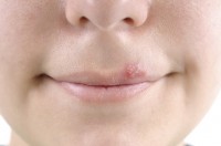 Een koortslip wordt veroorzaakt door een virusinfectie (herpes simplex) / Bron: Istock.com/Levent Konuk