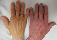 De hand van een persoon met ernstige bloedarmoede (links) vergeleken met een persoon zonder (rechts) / Bron: James Heilman, MD, Wikimedia Commons (CC BY-SA-3.0)