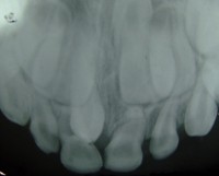 Boventallige tanden (hyperdontie) / Bron: Albert, Wikimedia Commons (Publiek domein)