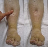 Gezwollen benen kent veel mogelijke oorzaken / Bron: James Heilman, MD, Wikimedia Commons (CC BY-SA-3.0)