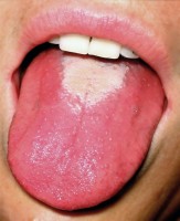Tongontsteking of glossitis / Bron: Martin Kronawitter, Wikimedia Commons (CC BY-SA-2.5)