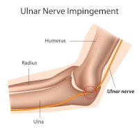 Nervus ulnaris syndroom / Bron: Alila Medical Media/Shutterstock