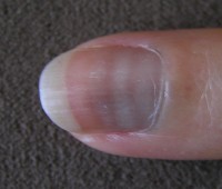gracht galop pijn doen Groeven of ribbels in nagels: oorzaken van geribbelde nagels | Mens en  Gezondheid: Aandoeningen