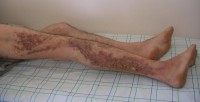 Ziekte van Darier op de benen / Bron: Mariame Meziane et al., Wikimedia Commons (CC BY-SA-3.0)