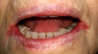 Mondhoekeczeem bij een ouder persoon met ijzergebreksanemie en een droge mond / Bron: Matthew Ferguson, Wikimedia Commons (CC BY-SA-3.0)
