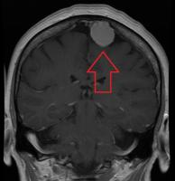MRI-beeld van een meningeoom met contrast / Bron: James Heilman, MD, Wikimedia Commons (CC BY-SA-4.0)