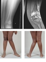 Voorbeeld van X-benen / Bron: BioMed Central, Wikimedia Commons (CC BY-2.0)