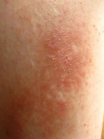 Lichen simplex chronicus op het scheenbeen / Bron: Eyon, Wikimedia Commons (CC BY-SA-3.0)