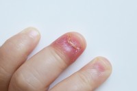 Omloop of nagelriemontsteking bij een kind / Bron: Zlikovec/Shutterstock.com