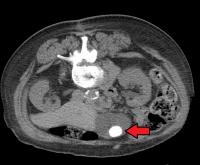 Grote galsteen te zien op een CT-scan / Bron: James Heilman, MD, Wikimedia Commons (CC BY-SA-4.0)