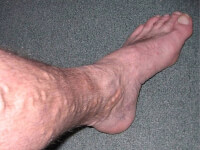 Spataderen in de benen kunnen pijn en ongemak veroorzaken / Bron: Self, Wikimedia Commons (Publiek domein)