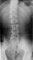 Röntgenfoto van de lumbale wervelkolom bij een staande patiënt met een scoliose / Bron: Lucien Monfils, Wikimedia Commons (CC BY-SA-3.0)