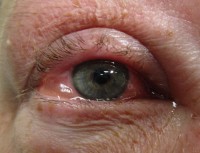 Jeukende ogen door allergische conjunctivitis / Bron: James Heilman, MD, Wikimedia Commons (CC BY-SA-4.0)