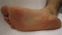 Hand-, voet- en mondziekte op de voet van een volwassene / Bron: James Heilman, MD, Wikimedia Commons (CC BY-SA-3.0)