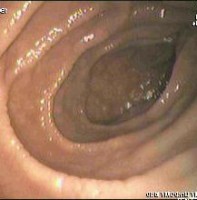 Endoscopie van het duodenum (twaalfvingerige darm) bij een patiënt met coeliakie / Bron: Onbekend, Wikimedia Commons (CC BY-SA-3.0)