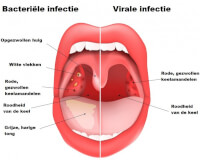 Bacteriële en virale keelontsteking / Bron: Designua/Shutterstock.com