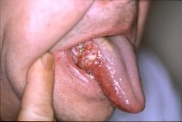 Kanker aan de zijkant van de tong / Bron: Welleschik, Wikimedia Commons (CC BY-SA-3.0)