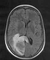 Schedel-MRI van een hersenmetastase met bijbehorend oedeem / Bron: Drahreg01, Wikimedia Commons (CC BY-SA-4.0)