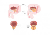 Een vergrote prostaat kan de urinestroom blokkeren / Bron: Ellepigrafica/Shutterstock