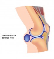 Bakerse cyste of kniekuilcyste / Bron: Alila Medical media/Shutterstock.com