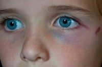 Kind met blauw oog / Bron: Humbert15, Flickr (CC BY-2.0)