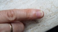 Symptomen van nagelpsoriasis op de pinknagel / Bron: Martin Sulman