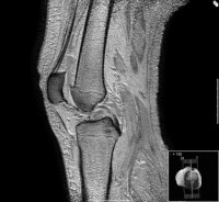 <I>Figuur 6. MRI scan van een knie</I> / Bron: Scuba-limp, Wikimedia Commons (CC BY-SA-3.0)
