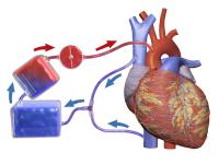 Een overzicht van hoe de hart-longmachine wordt aangesloten. Blauw bloed is zuurstofarm, rood is zuurstofrijk. / Bron: Blausen Medical Communications, Wikimedia Commons (CC BY-3.0)