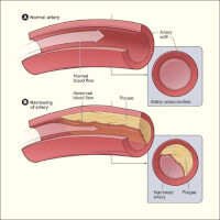 Bij atherosclerose ontstaat er een plaque in je slagaderen, die zorgt voor een abnormale bloedstroming omdat er minder ruimte is voor het bloed om te stromen.  / Bron: NHLBI, Wikimedia Commons (Publiek domein)