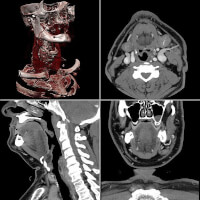 Een voorbeeld van een CT-scan. Uit een heleboel verschillende lichaamsdoorsneden (de tweedimensionale zwart-witte afbeeldingen) kan de computer een driedimensionaal beeld geven (linksboven).  / Bron: En:ChumpusRex, Wikimedia Commons (CC BY-SA-3.0)