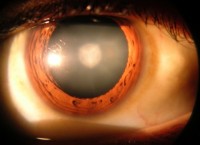 Close-up oog met staar / Bron: Rakesh Ahuja, MD, Wikimedia Commons (CC BY-SA-3.0)