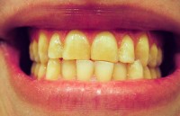 Tandenknarsen (bruxisme) is één van de mogelijke oorzaken van kaakpijn. / Bron: En:DRosenbach, Wikimedia Commons (Publiek domein)